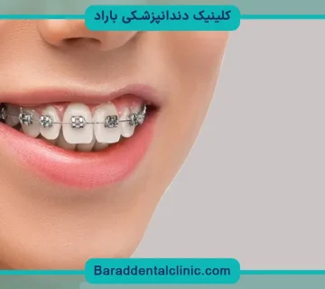 سیم کشی دندان چند سال طول میکشد؟