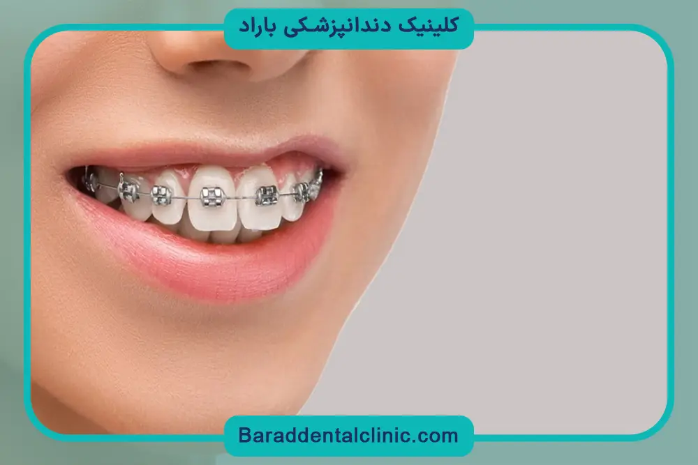 سیم کشی دندان چند سال طول میکشد؟