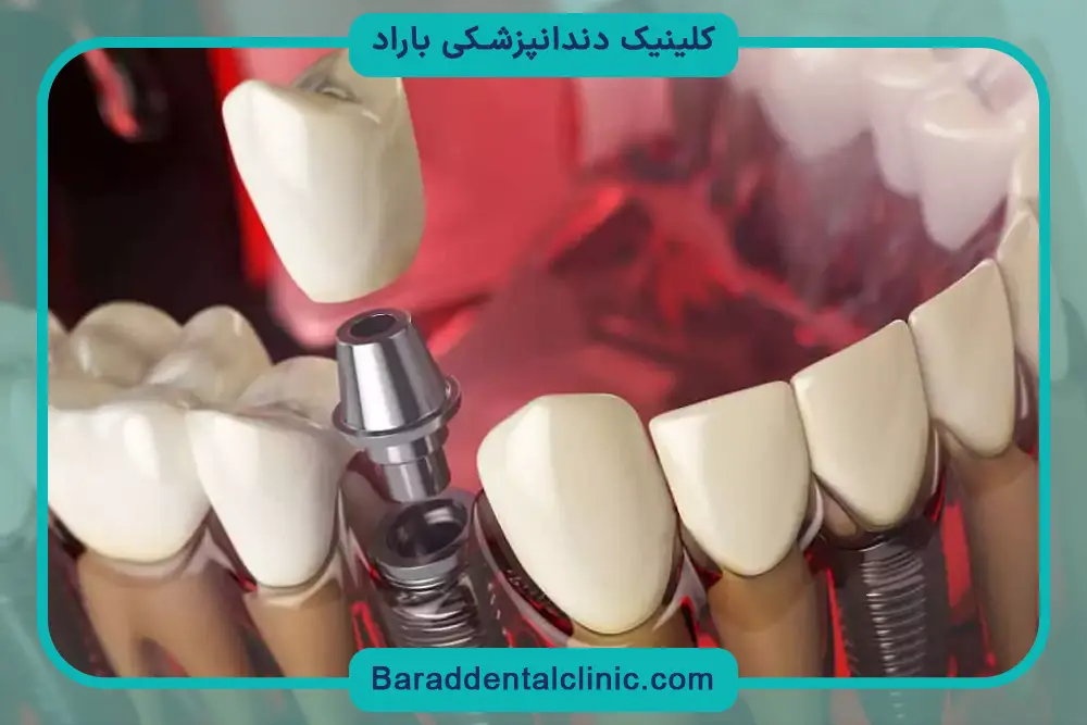 مزایای ایمپلنت ثابت دندان 
