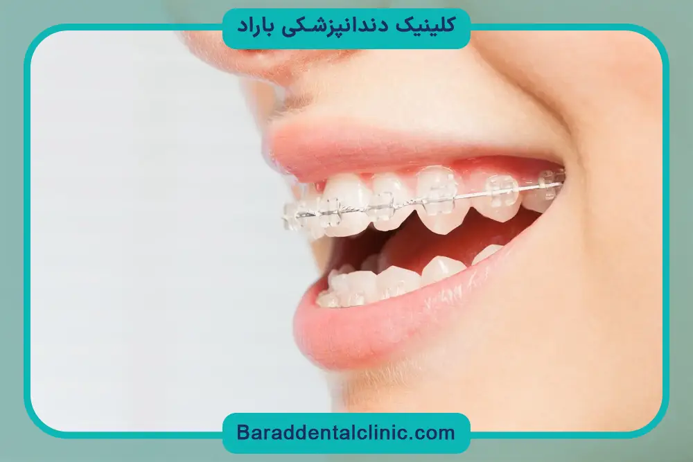 سیم کشی دندان چیست؟ بررسی کلی