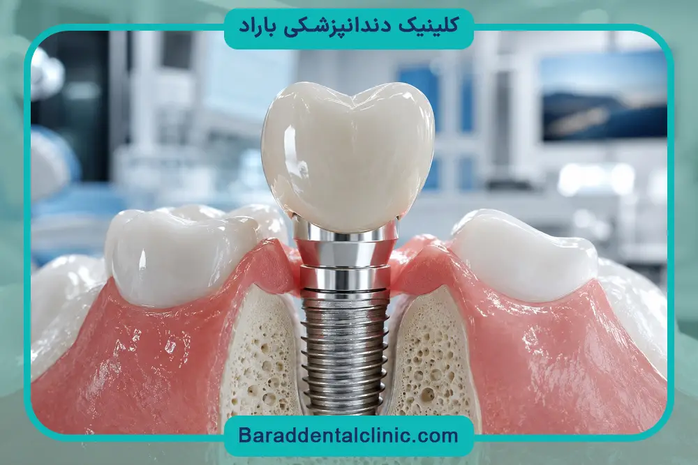 خطرات ایمپلنت ارزان دندان 