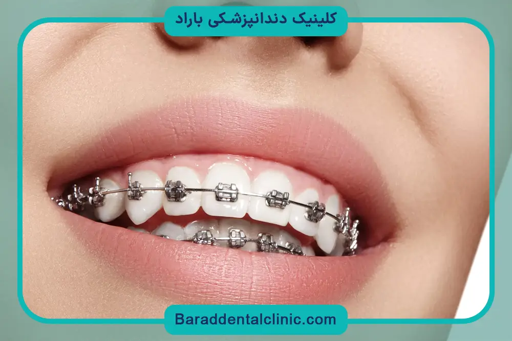 سیم کشی دندان چند سال طول میکشد؟ نقش همکاری با پزشک