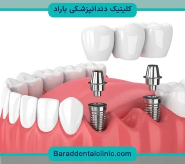 هزینه ایمپلنت دندان