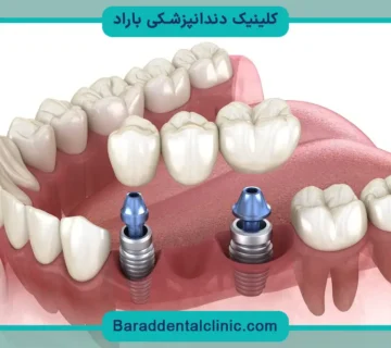 کاشت دندان بدون ایمپلنت