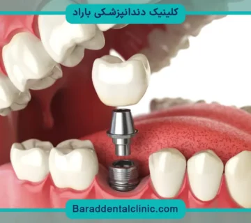 کاشت دندان تکی جلو