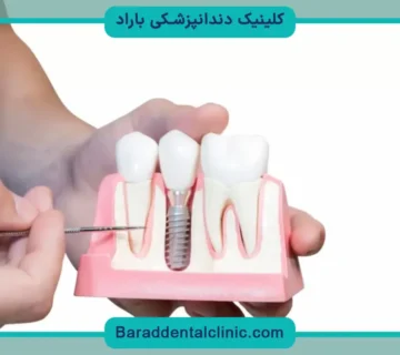 کاشت دندان جدید