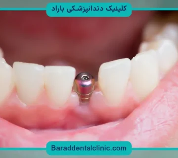 کاشت دندان مصنوعی