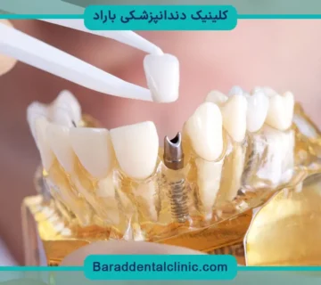 کاشت دندان طبیعی