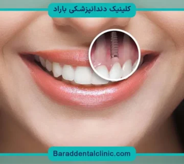 کاشت دندان جلویی