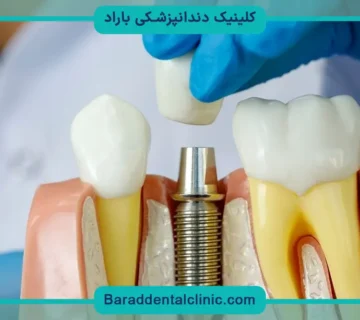 ایمپلنت دندان چقدر هزینه دارد