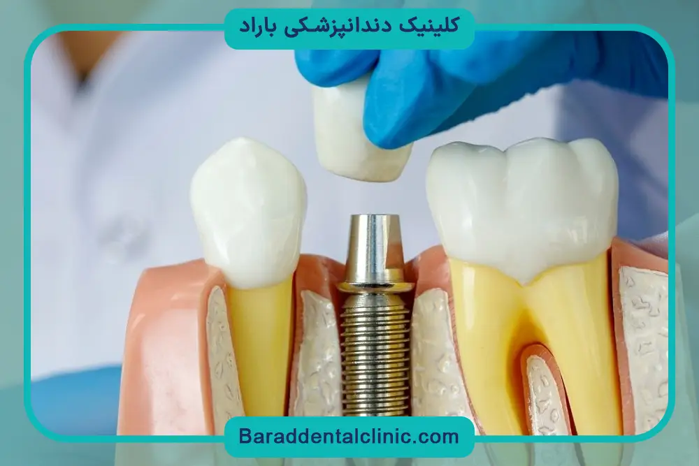 ایمپلنت دندان چقدر هزینه دارد
