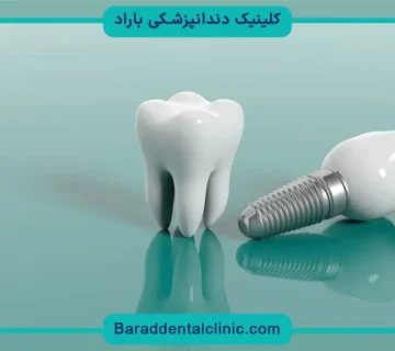 هزینه کاشت ایمپلنت