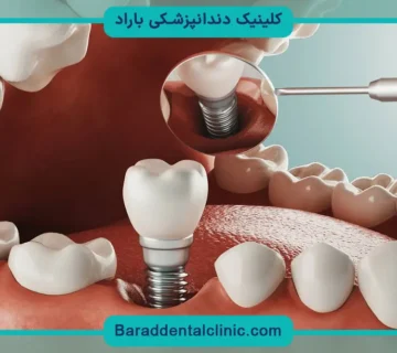 هزینه ایمپلنت
