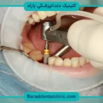 هزینه درمان ایمپلنت دندان