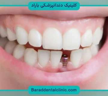 جراحی کاشت دندان