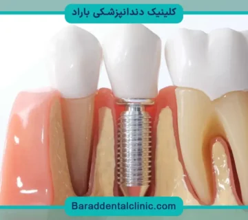 کاشت دندان تک