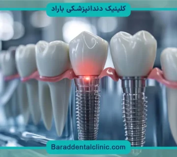 کاشت دندان بدون ایمپلنت قیمت