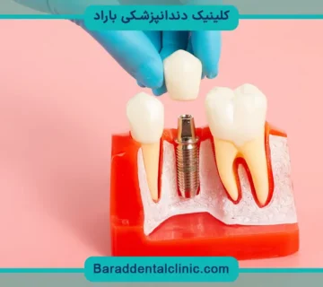 کاشت دندان پروتز
