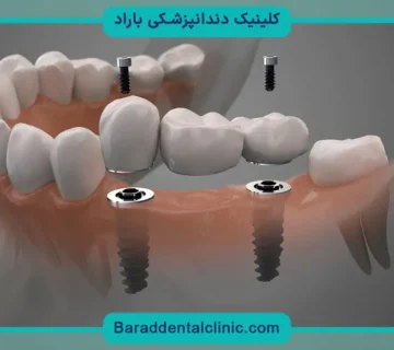 کاشت دندان پروتز ثابت