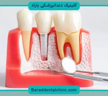 کاشت دندان بدون ایمپلنت با تکنولوژی جدید