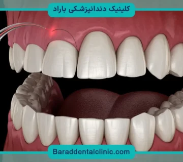کاشت دندان جلو بالا