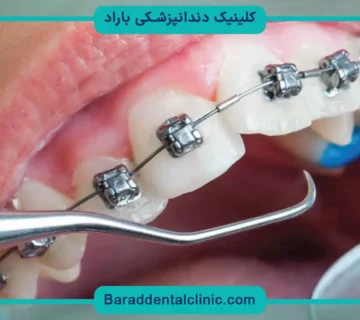 هزینه ارتودنسی با بیمه تامین اجتماعی