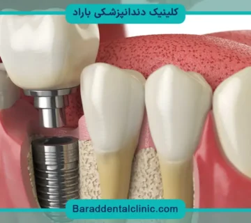 Punch Implant Technique