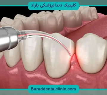 هزینه ایمپلنت در شهرهای ایران