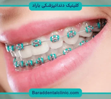 قیمت ارتودنسی چهار دندان جلو