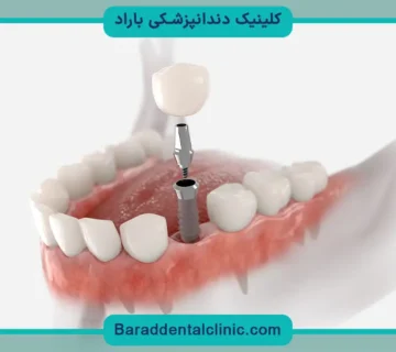 کاشت دندان پیچی