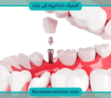 قیمت ایمپلنت کامل فک بالا و پایین