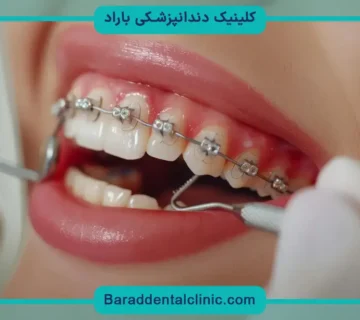 قیمت ارتودنسی دندان فک بالا