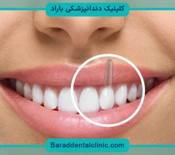هزینه ایمپلنت دندان با بیمه