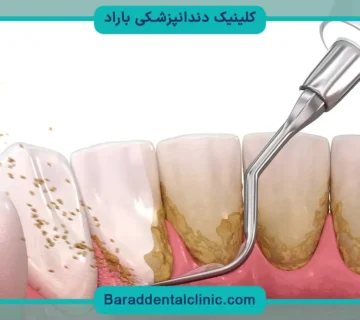 کاشت دندان پل ثابت