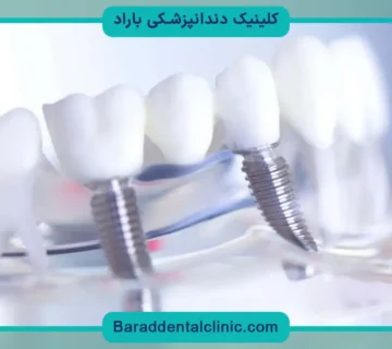 جدیدترین تکنولوژی کاشت دندان