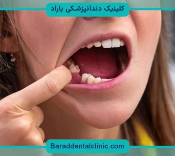 تاثیر برند ایمپلنت بر قیمت