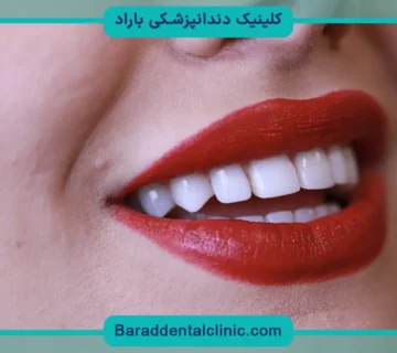 روش های مرتب سازی دندان