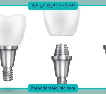 جدیدترین نوع کاشت دندان