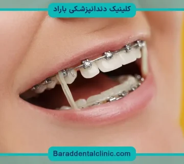 کش ارتودنسی