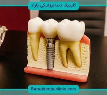 جدیدترین کاشت دندان