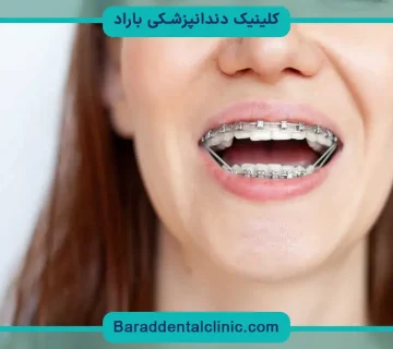رگلاژ دندان تهران