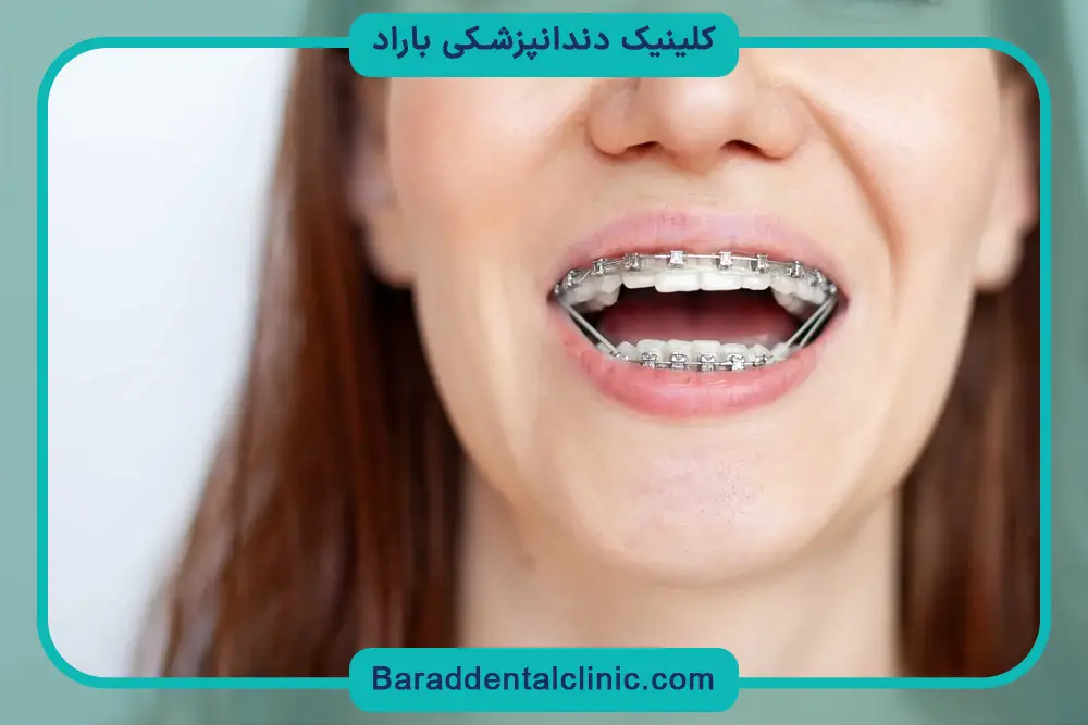 رگلاژ دندان تهران