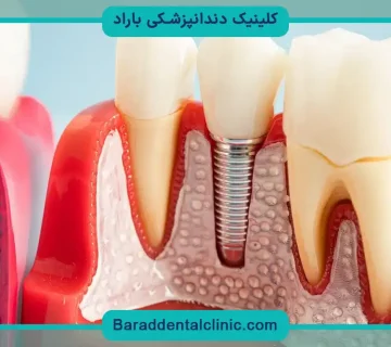تفاوت ایمپلنت ثابت و متحرک