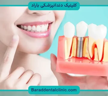 عکس ایمپلنت دندان قبل و بعد
