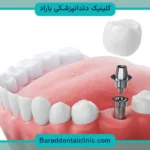 جلوگیری از عفونت ایمپلنت