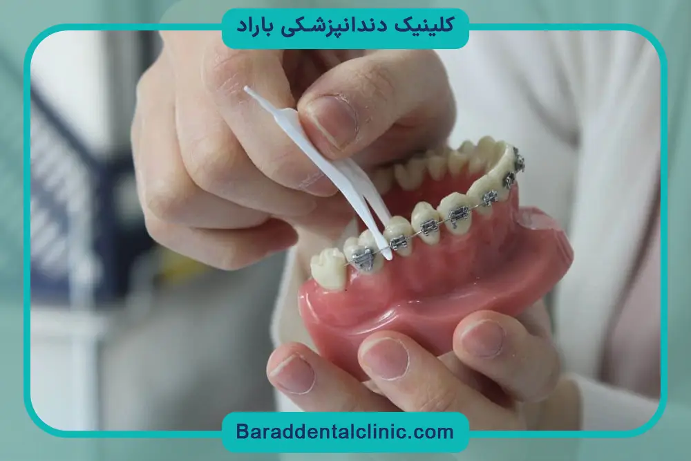 نخ دندان ارتودنسی
