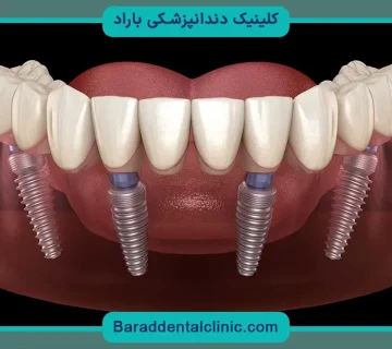 کاشت دندان چگونه است