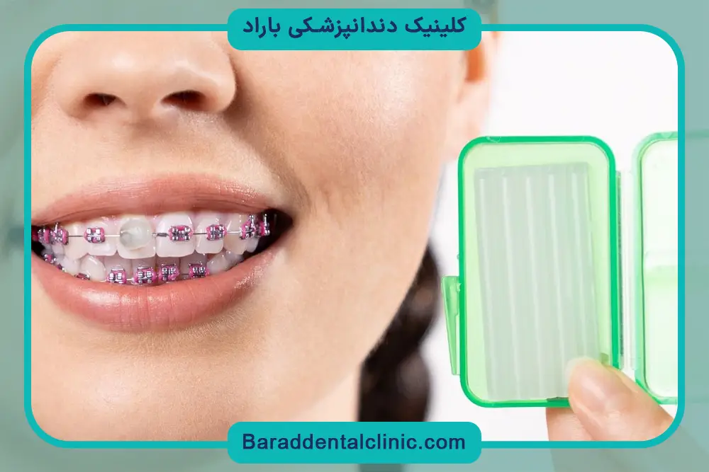 موم ارتودنسی