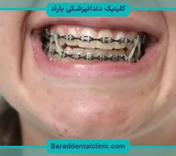 صاف كردن دندان بدون ارتودنسي