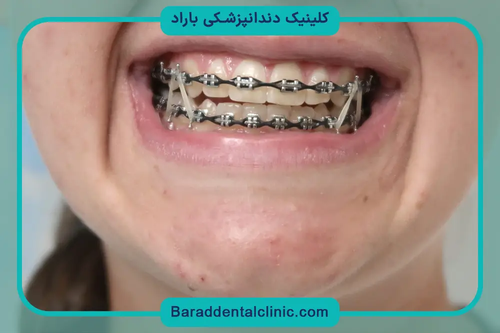صاف كردن دندان بدون ارتودنسي
